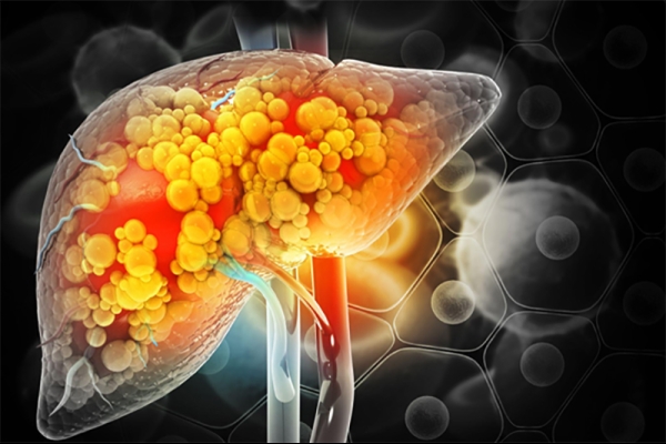 10 Signs You May Have Fatty Liver Disease