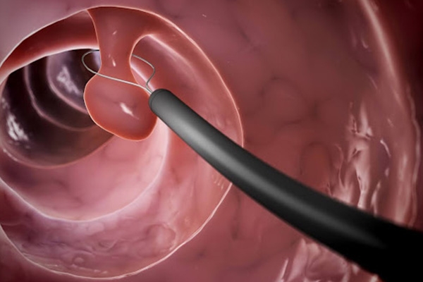 Polyps Found During Colonoscopy: What Does It Actually Mean?